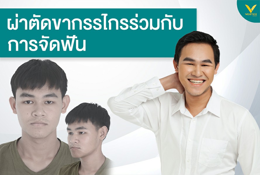 ผ่าตัดขากรรไกรร่วมกับการจัดฟัน