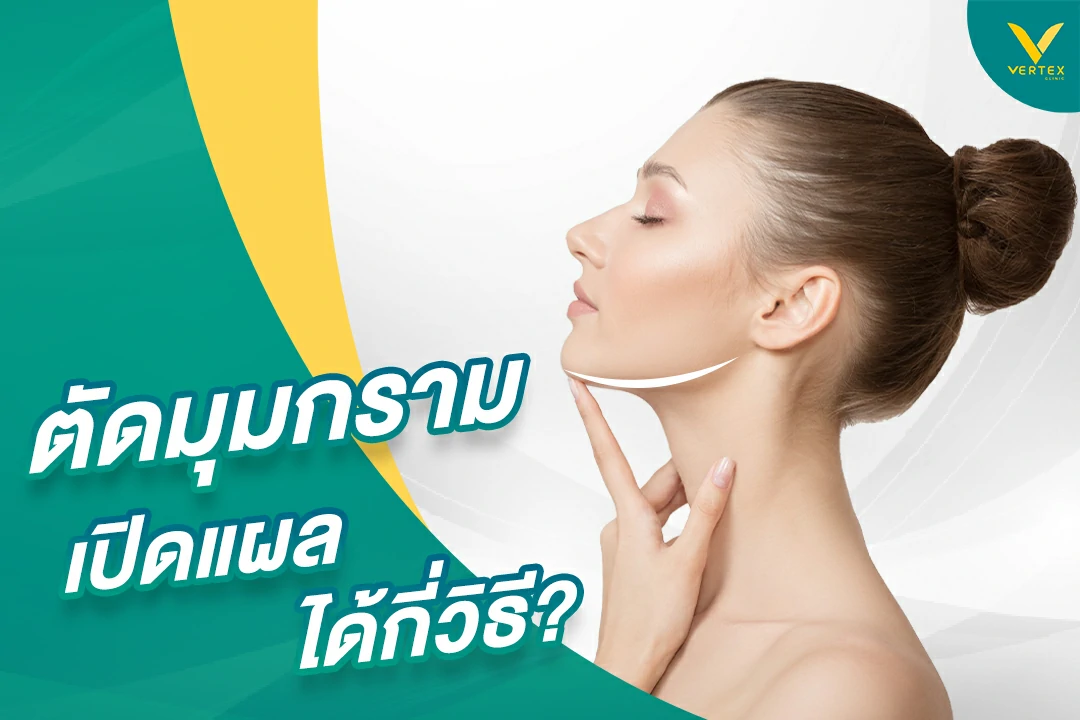 ผ่าตัดมุมกรามเปิดแผลแบบไหนได้บ้าง แบบไหนที่นิยมกว่ากัน
