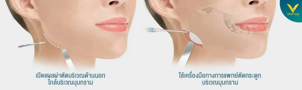 ผ่าตัดกรามเปิดแผลนอกมีรอยแผลเป็นไหม