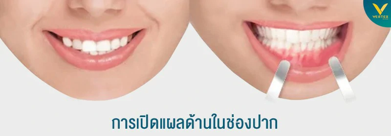 ผ่าตัดกรามเปิดแผลในช่องปากดีกว่าแผลนอกช่องปากอย่างไร