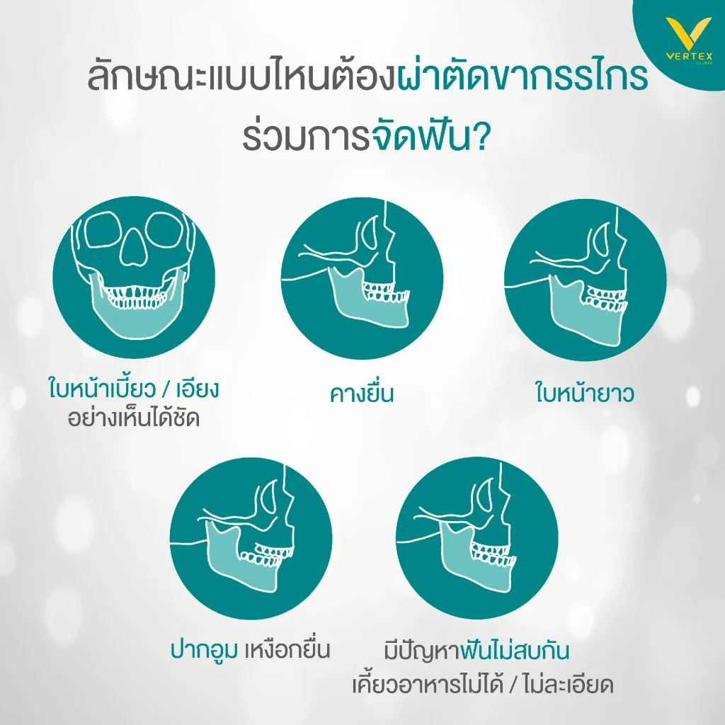 คางยื่น ควรผ่าตัดขากรรไกรหรือไม่