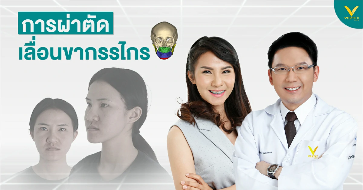การสบฟันผิดปกติ ต้องผ่าตัดเลื่อนขากรรไกรหรือไม่