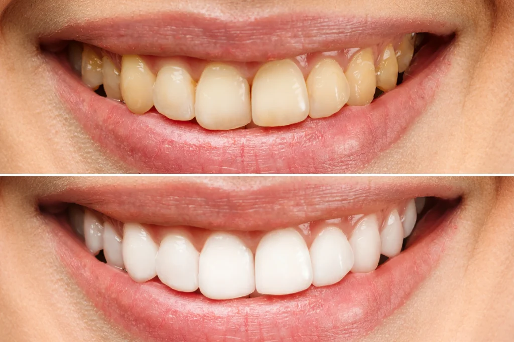 10 วิธีแก้ปัญหาฟันเหลืองง่าย ๆ 10 วิธีแก้ปัญหาฟันเหลืองง่าย ๆ