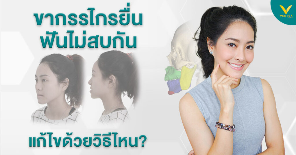 ขากรรไกรยื่น คางยื่น
