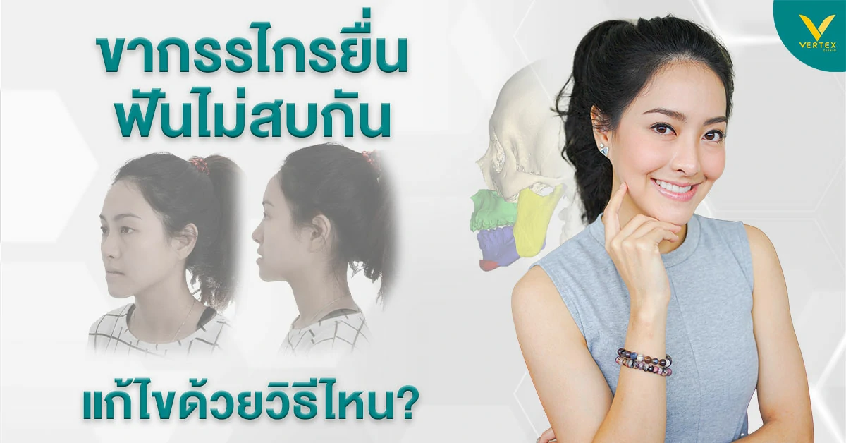 ขากรรไกรยื่น
