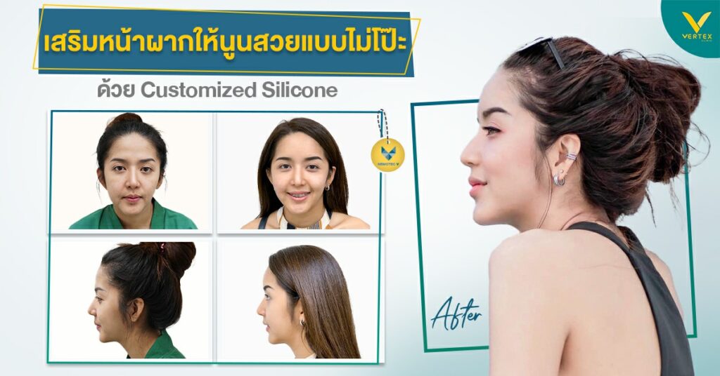 เสริมหน้าผากด้วยซิลิโคนรีวิว