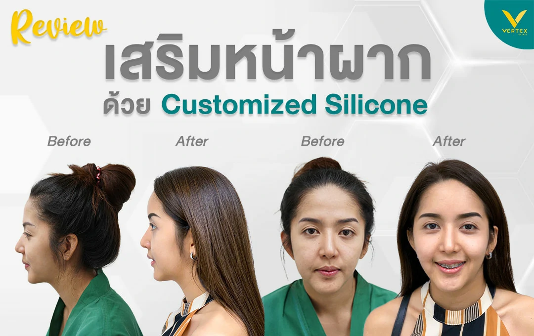 รีวิวเสริมหน้าผากซิลิโคนเฉพาะบุคคล