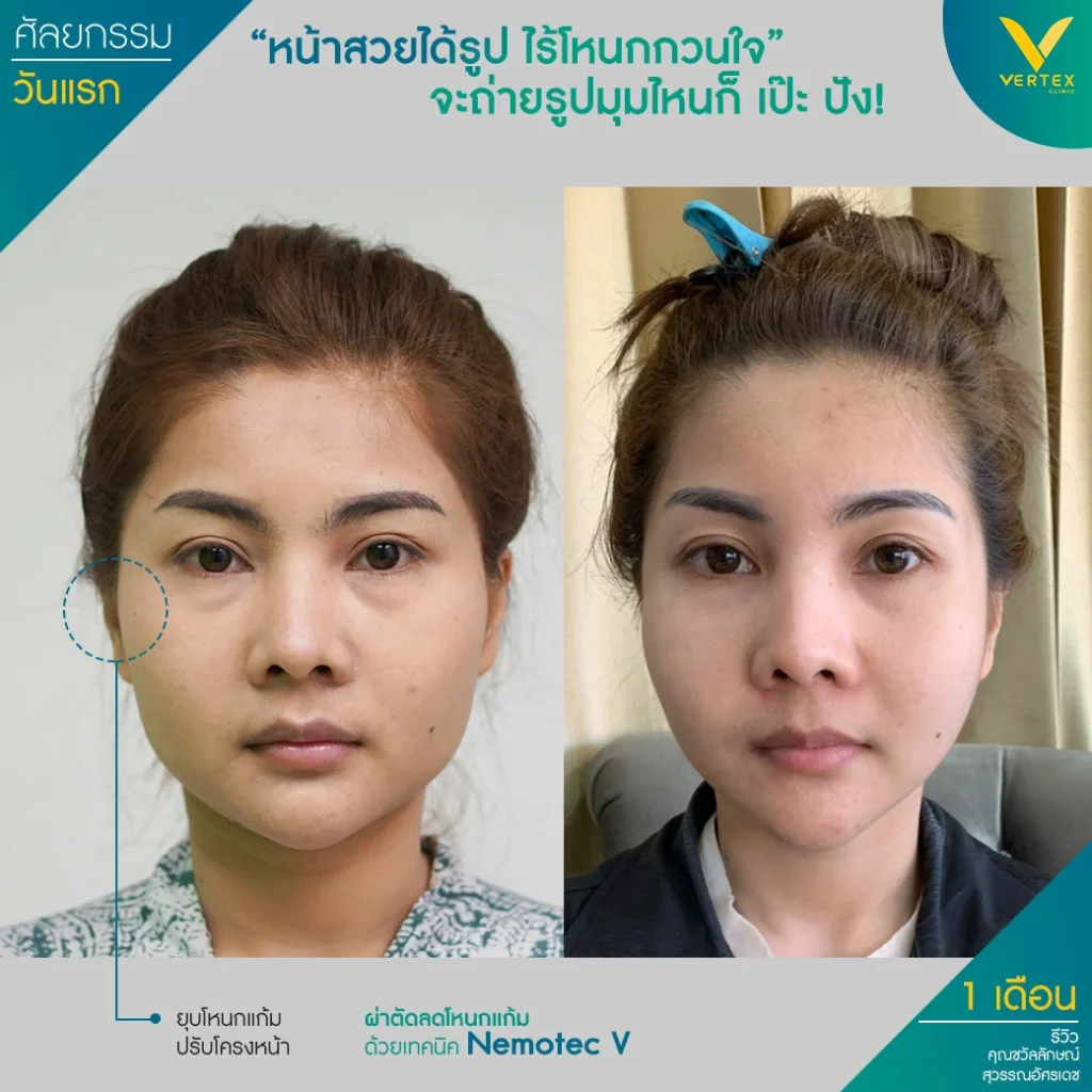 รีวิวลดโหนกแก้ม