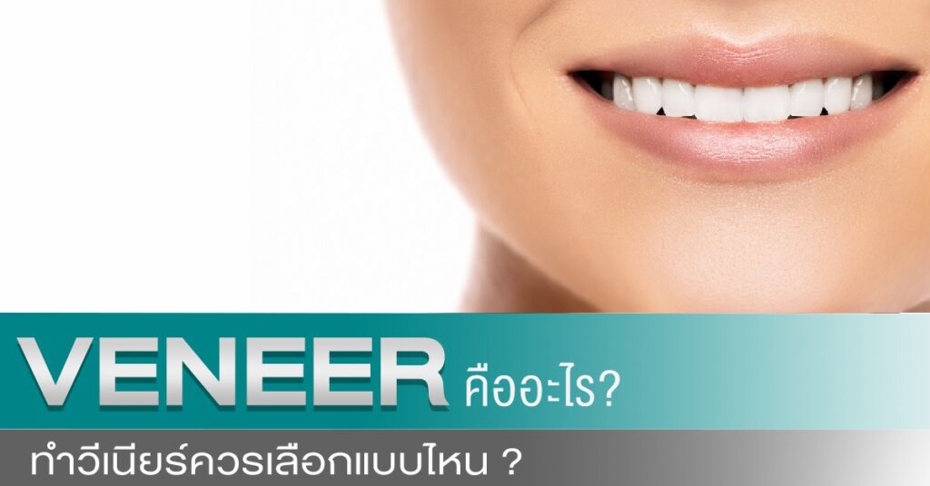 วีเนียร์คือ แปะฟันขาว วีเนียร์
