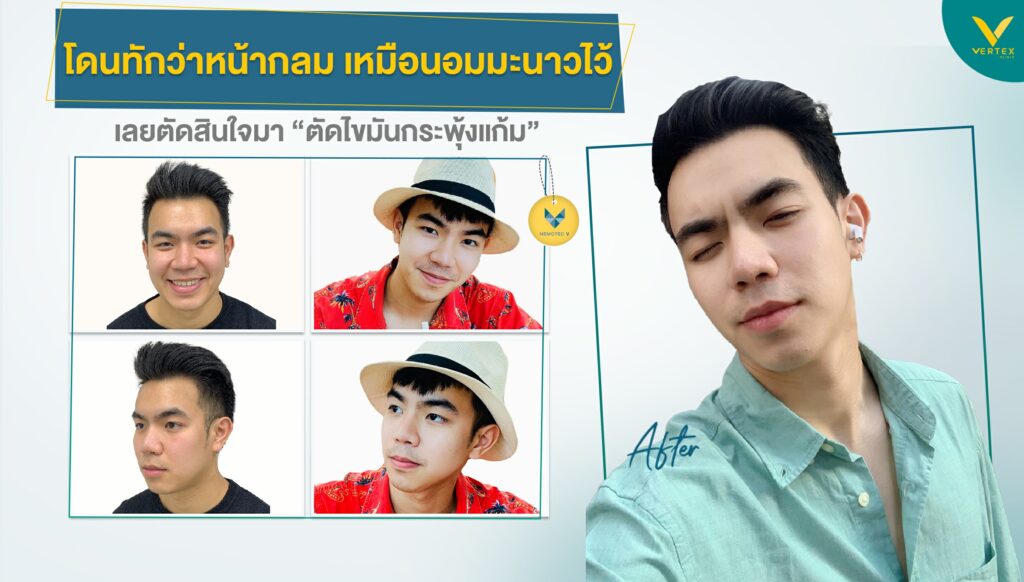 รีวิวตัดกระพุ้งแก้ม เรียวจริงไม่จกตา