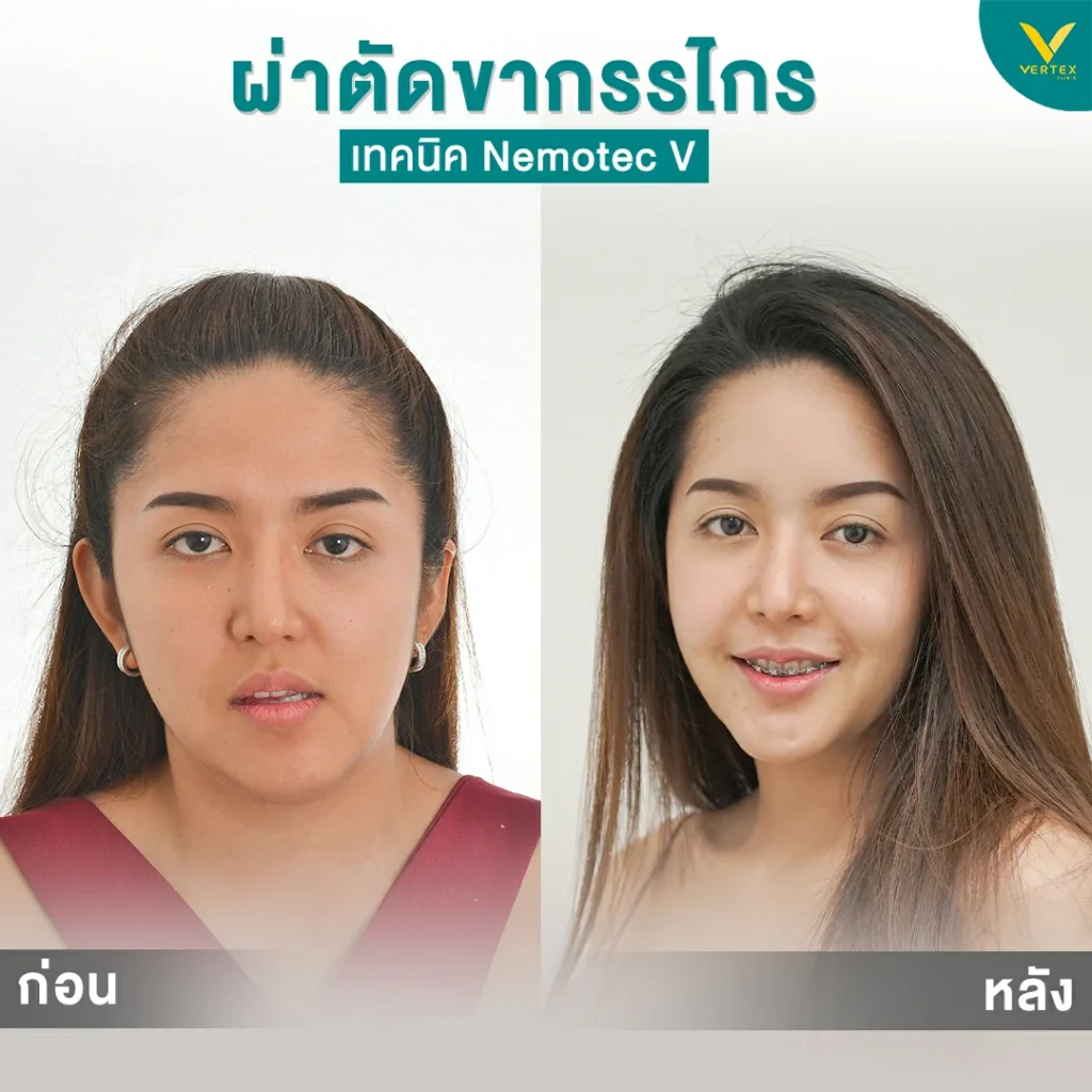 ใบหน้าไม่เท่ากัน เกิดจากอะไร? ปรับรูปหน้าให้เท่ากัน ด้วยวิธีไหนบ้าง? ใบหน้าไม่เท่ากัน เกิดจากอะไร? ปรับรูปหน้าให้เท่ากัน ด้วยวิธีไหนบ้าง?