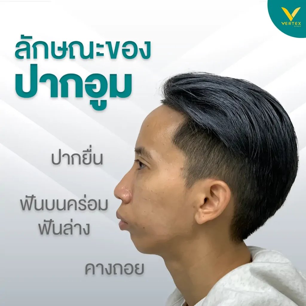 ลักษณะของปากอูมยื่น คางหด