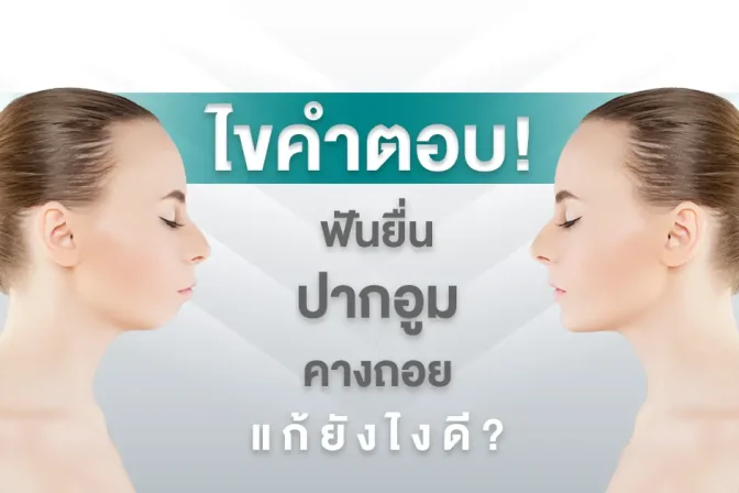ฟันยื่น ปากอูม คางหด เกิดจาก? ปากอูม แก้ยังไง ศัลยกรรมปากอูมมีอะไรบ้าง