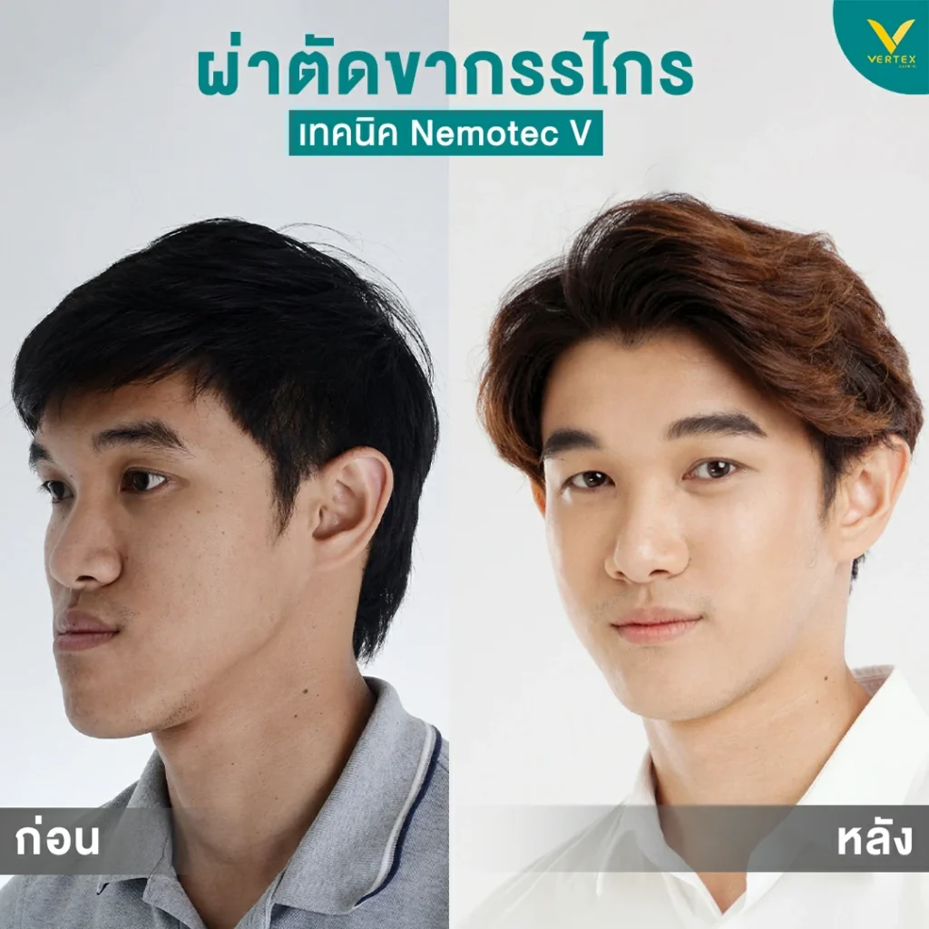 รีวิวขากรรไกร