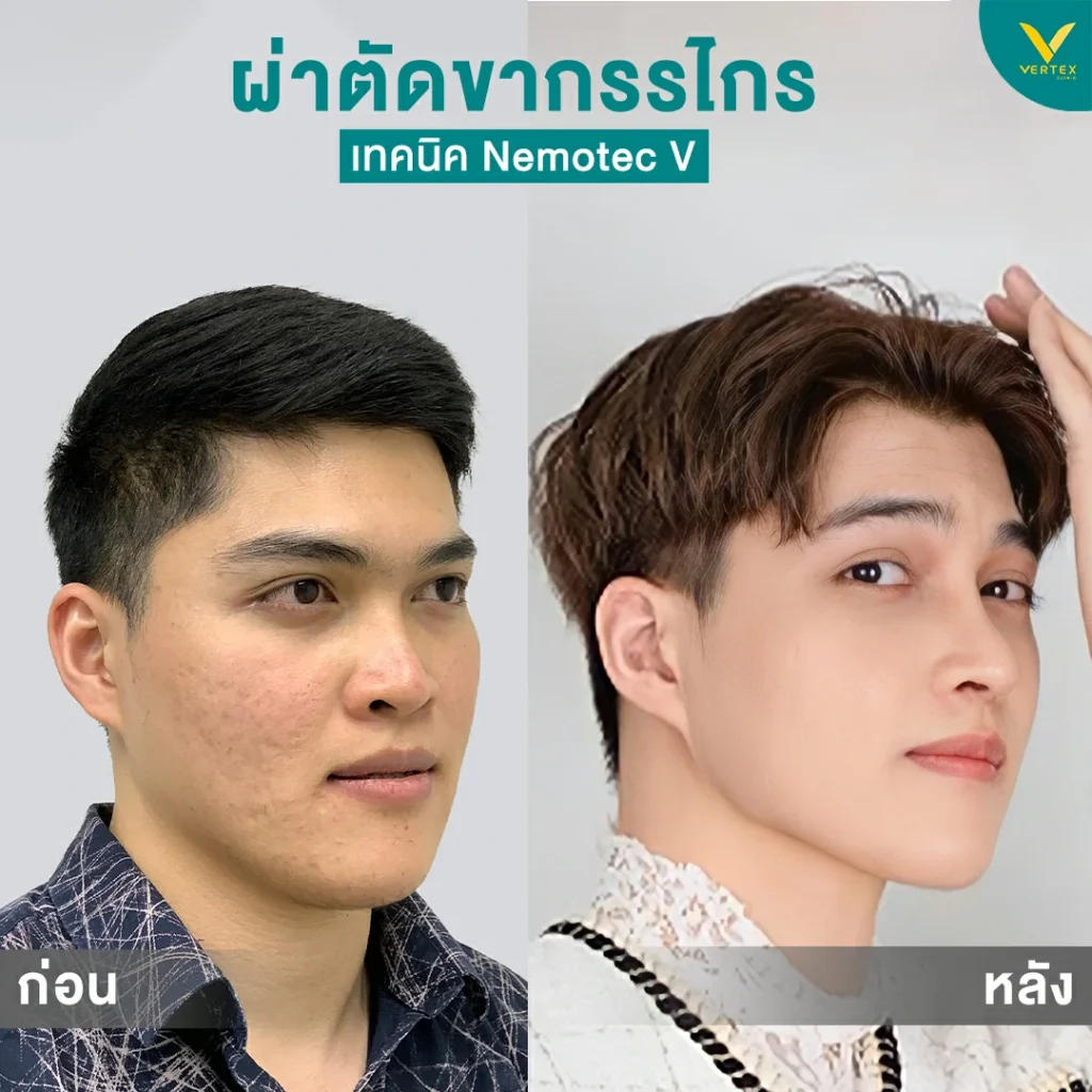 รีวิวขากรรไกร