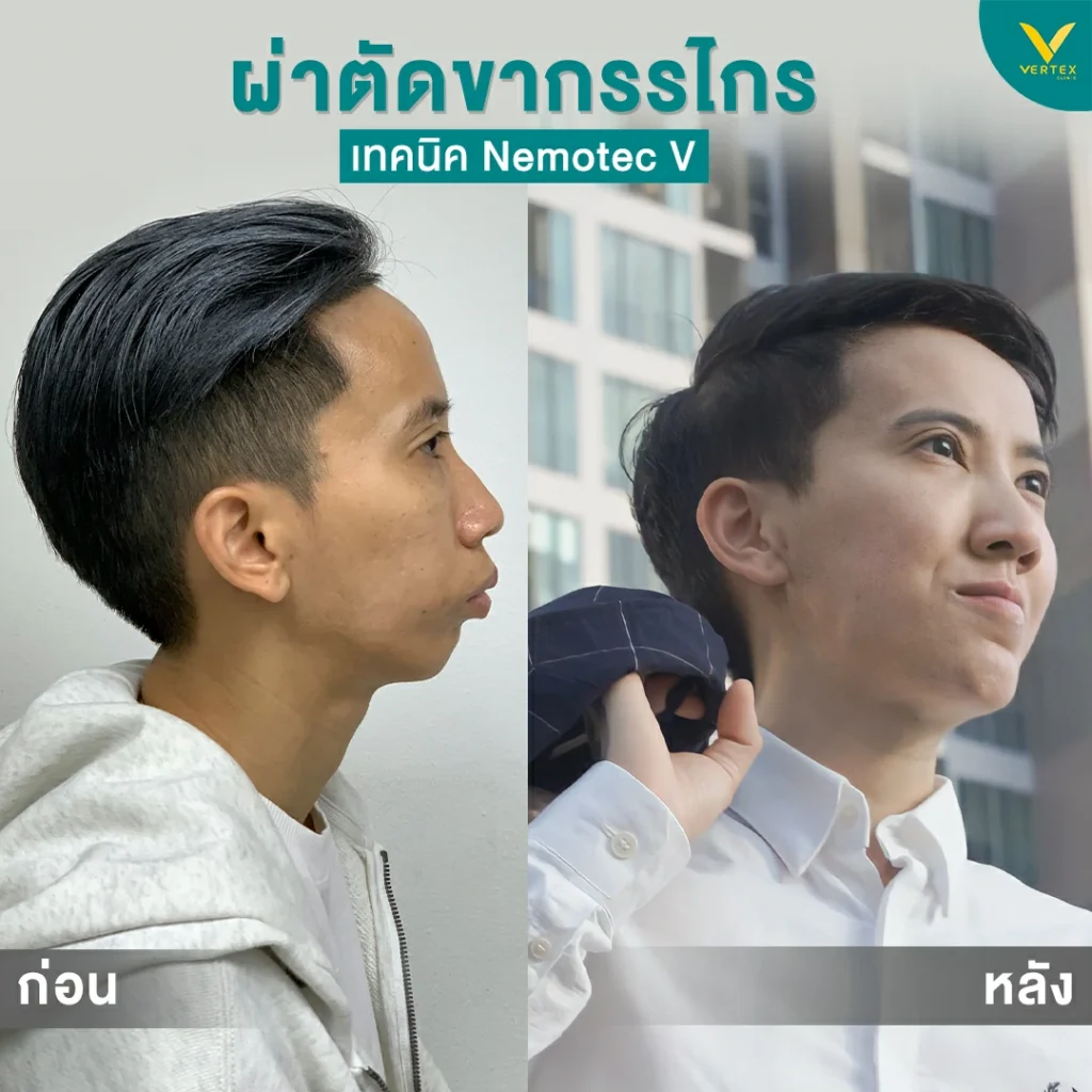 รีวิวขากรรไกร