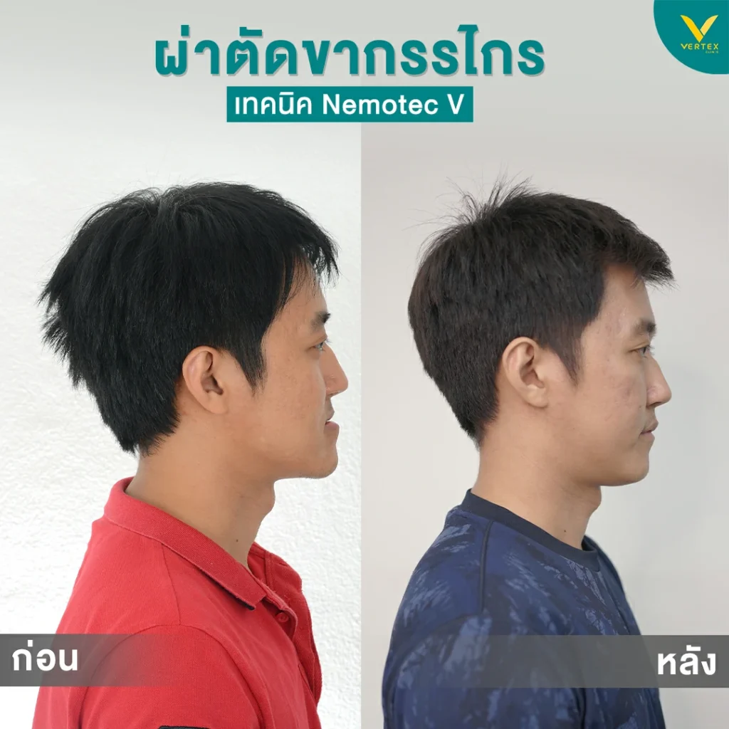 รีวิวขากรรไกร