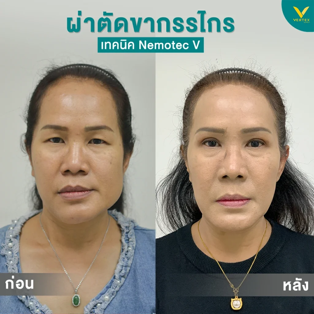 รีวิวขากรรไกร