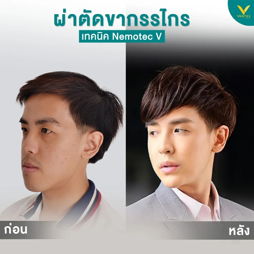 รีวิวขากรรไกร