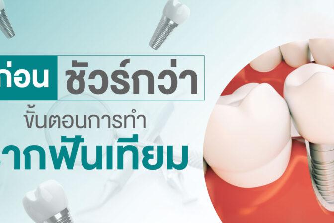 รู้ก่อนชัวร์กว่า ขั้นตอนการทำรากฟันเทียม