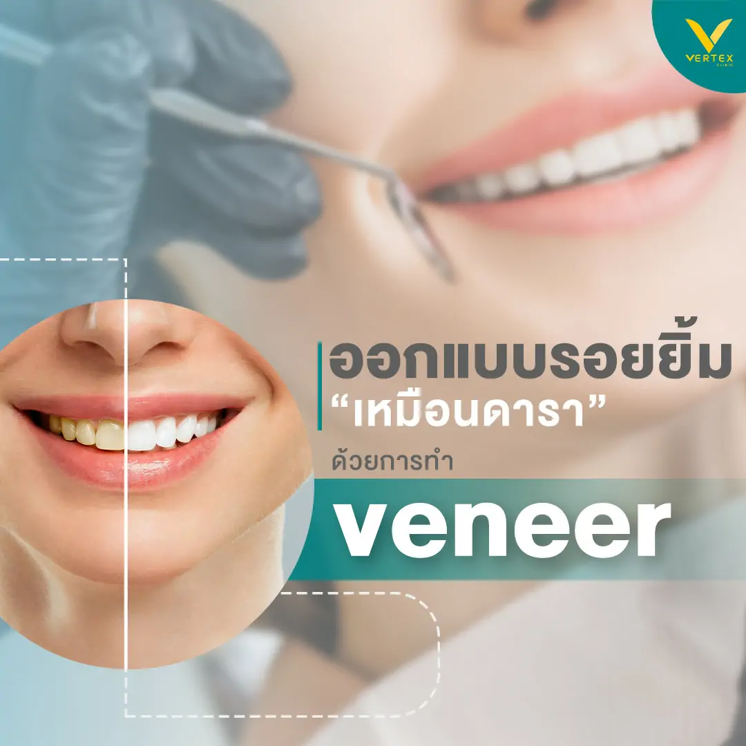 วีเนียร์ เคลือบฟันขาว แปะฟันขาว (Veneer)