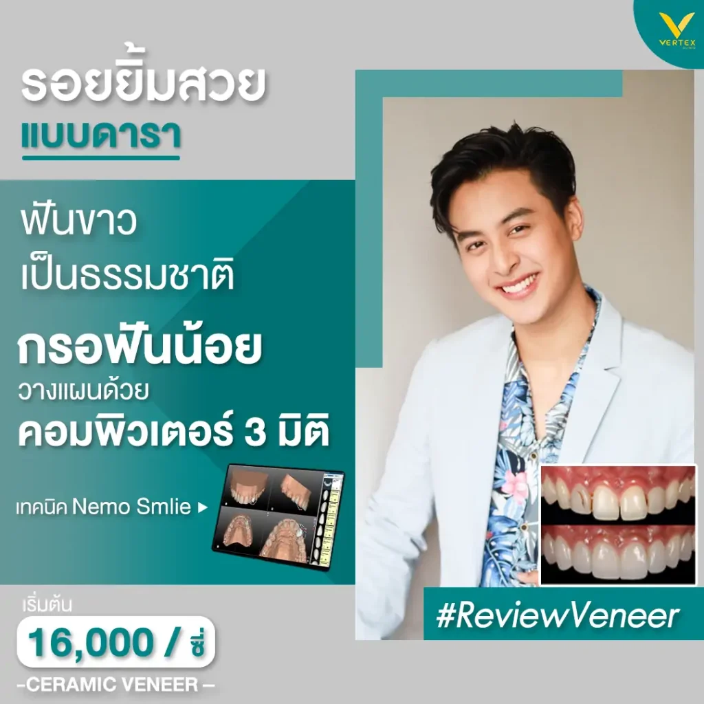 ceramic veneer วีเนียร์เซรามิก