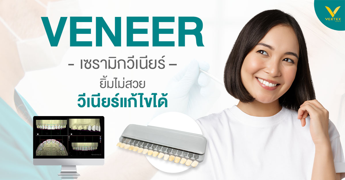 Veneer E-max