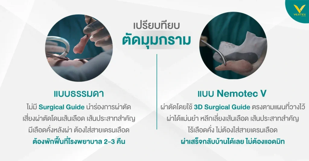 เปรียบเทียบการตัดกรามธรรมดากับ Nemotec V