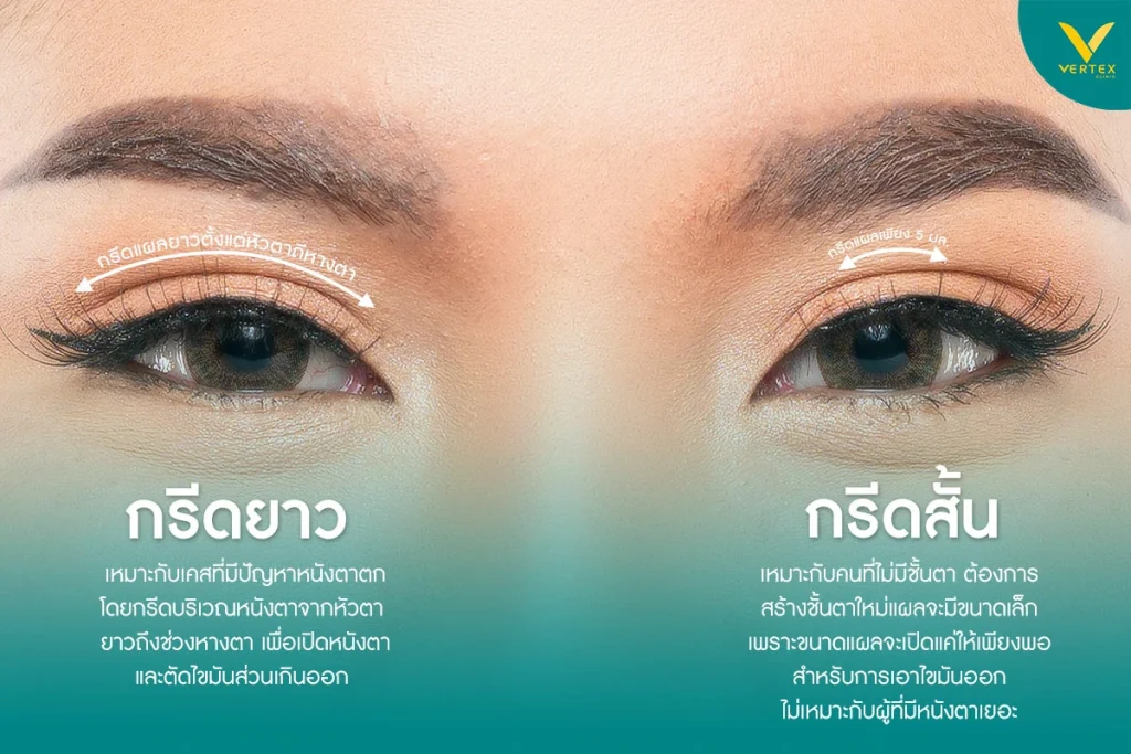 กรีดตาแบบสั้น - กรีดตาแบบยาว - ทำตาสองชั้นราคาเท่าไหร่