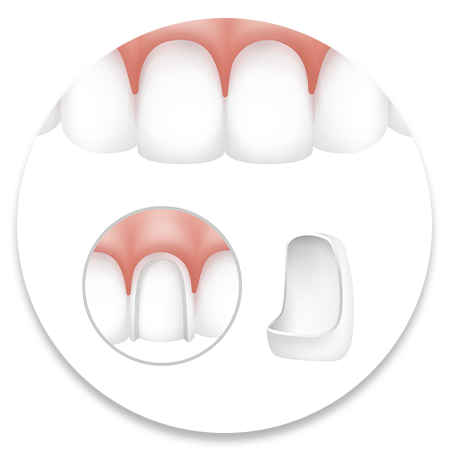 Veneer
