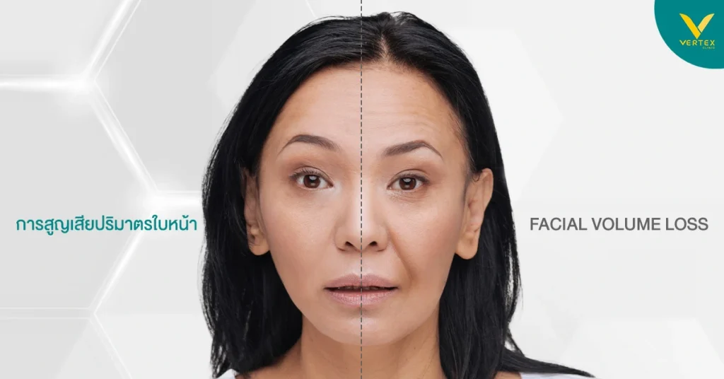 การสูญเสียปริมาตรใบหน้า