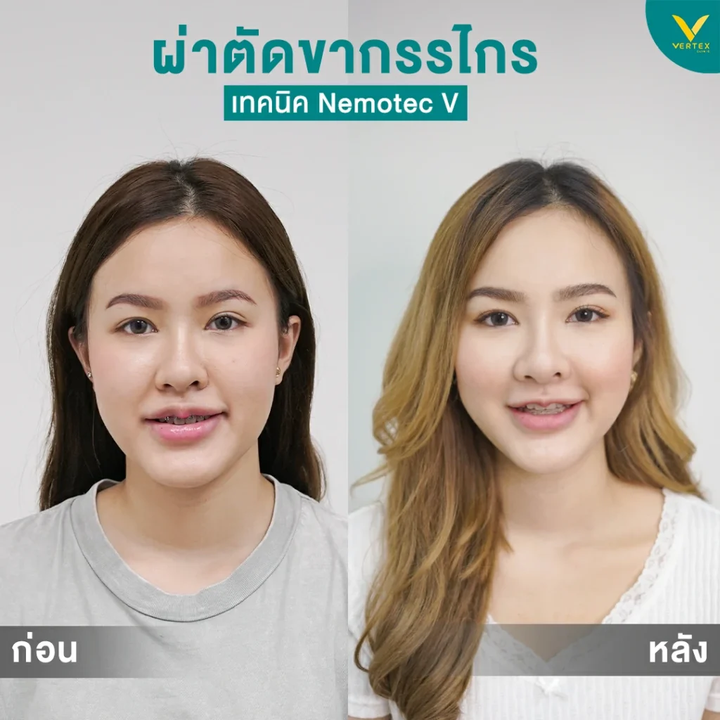 รีวิวผ่าตัดขากรรไกร 2