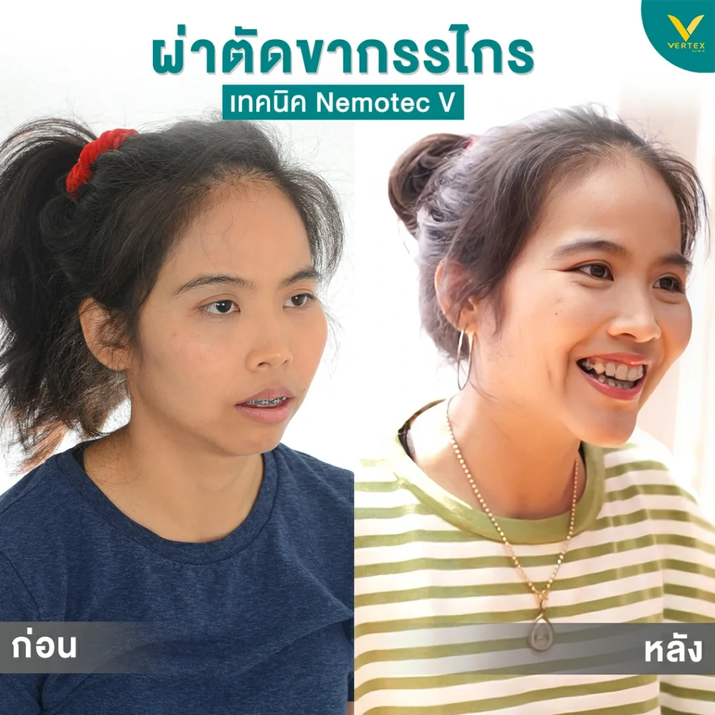 รีวิวผ่าตัดขากรรไกร 5