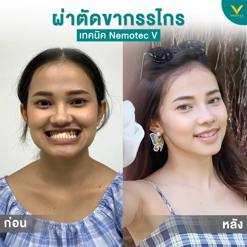 รีวิวผ่าตัดขากรรไกร 8