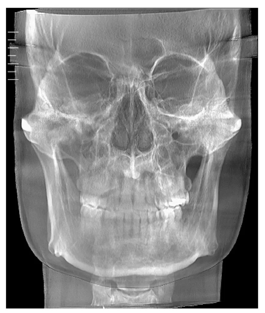 ภาพ CT Scan
