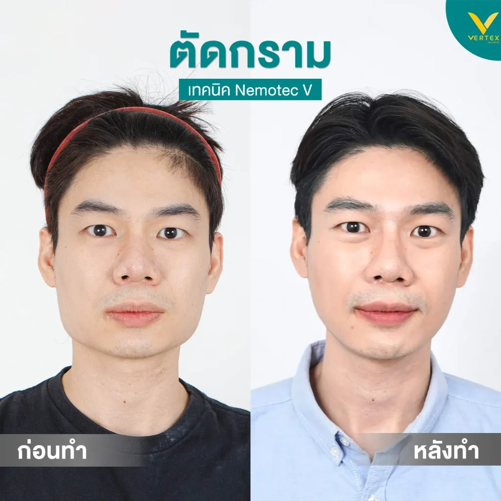 ภาพก่อน - หลังการผ่าตัดกราม 
