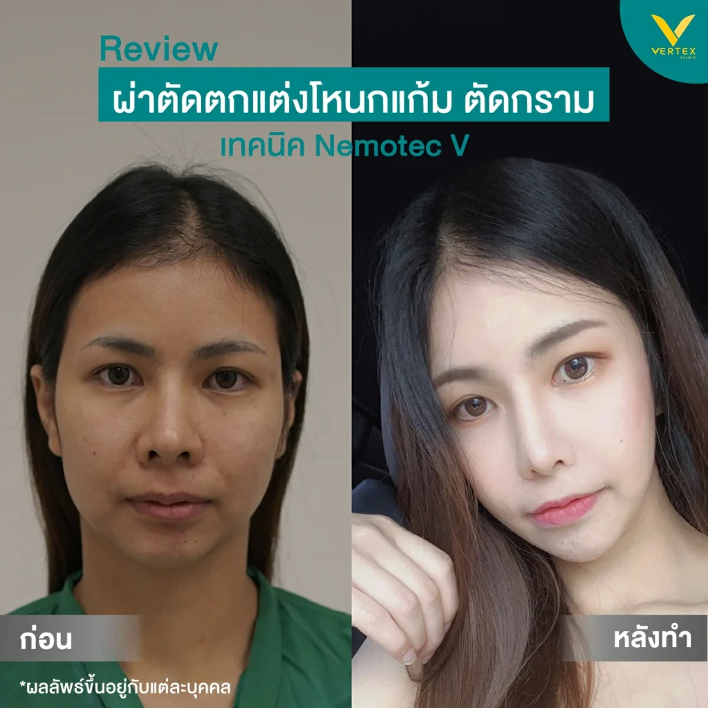 รีวิวโหนกแก้ม-กราม