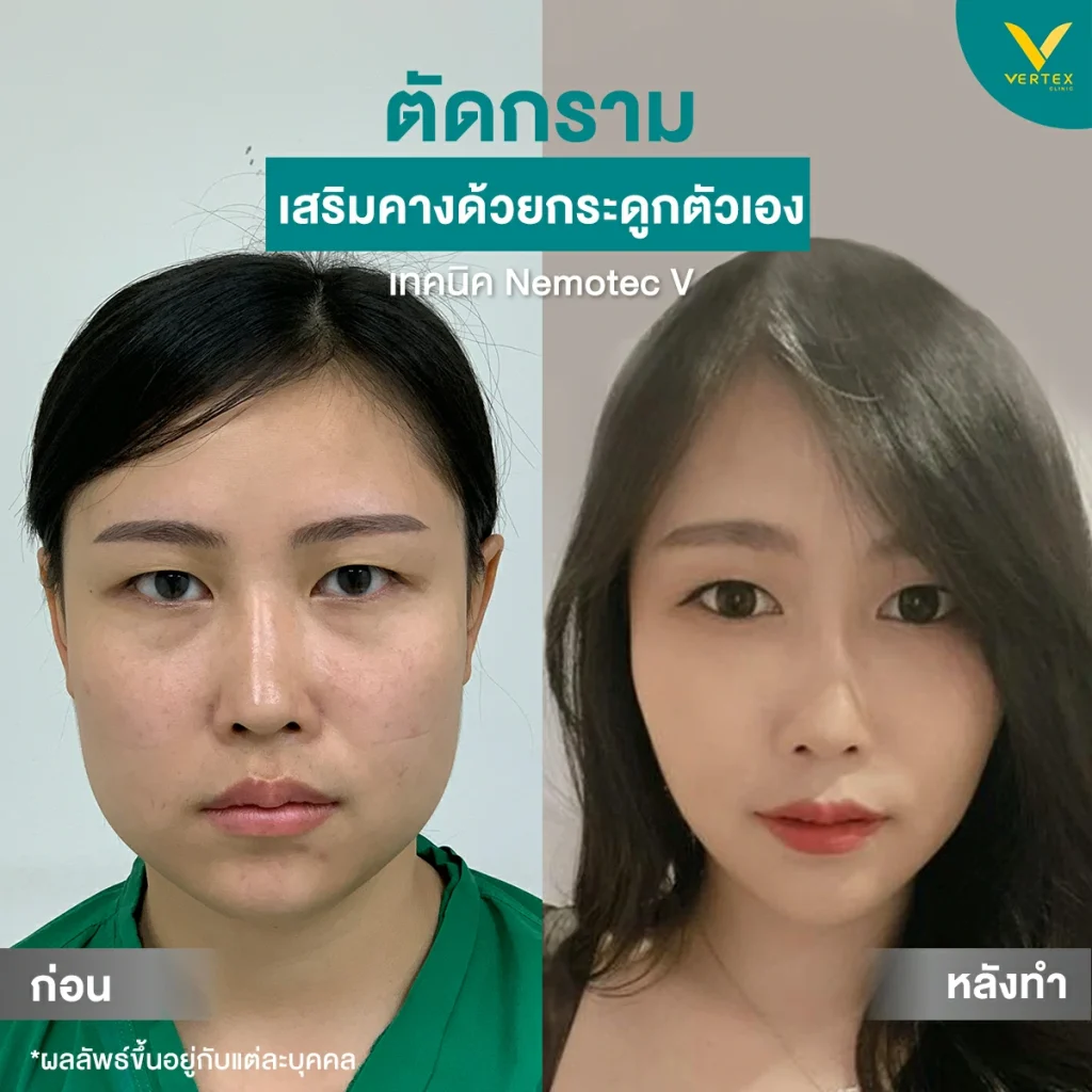 รีวิวีตัดกราม-คุณชมพู่