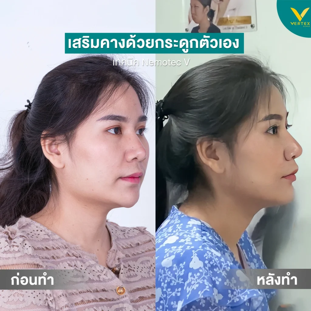 Before & After เสริมคางด้วยกระดูกตัวเอง Before & After เสริมคางด้วยกระดูกตัวเอง