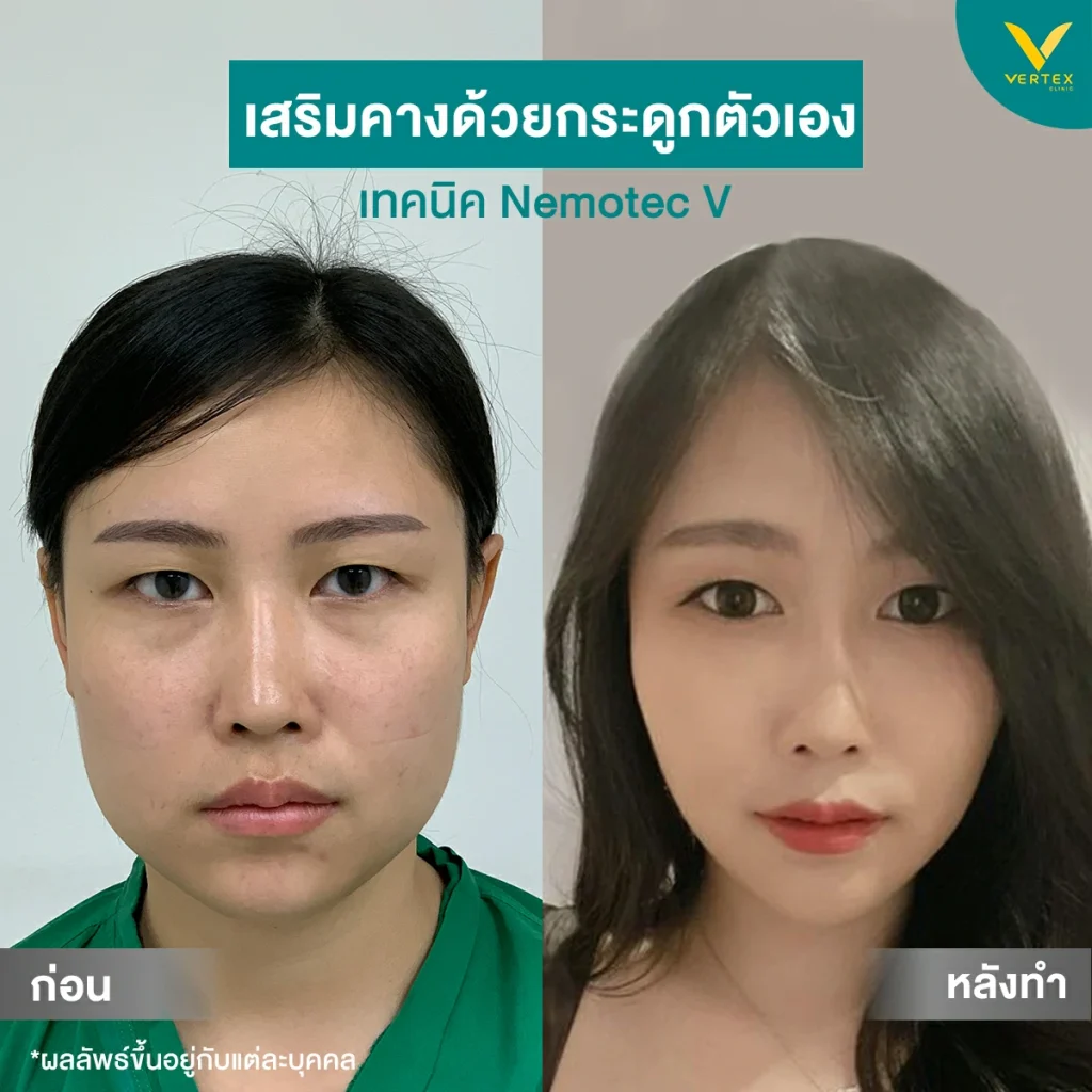 Before & After เสริมคางด้วยกระดูกตัวเอง Before & After เสริมคางด้วยกระดูกตัวเอง