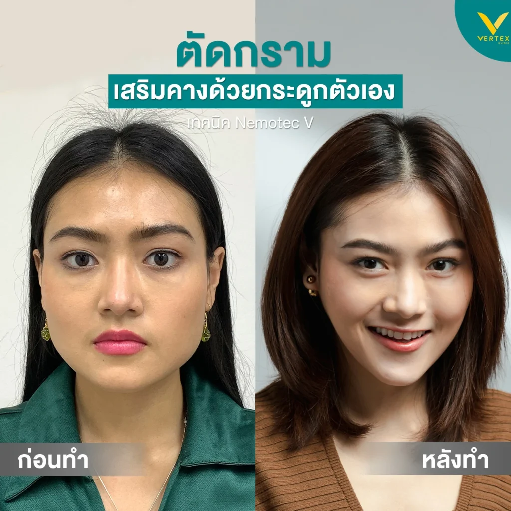รีวิวตัดกราม-คาง-คุณสุมนกาญจน์-ตัดกาม