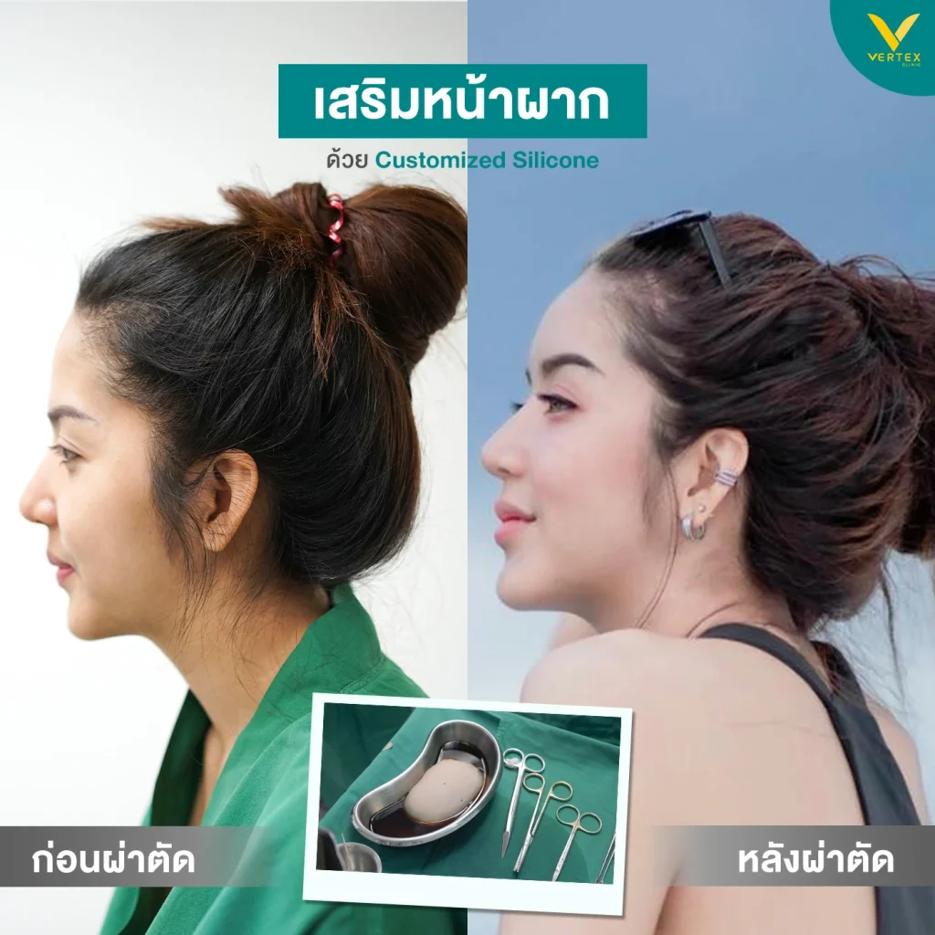 รีวิวหน้าผากคุณนัส