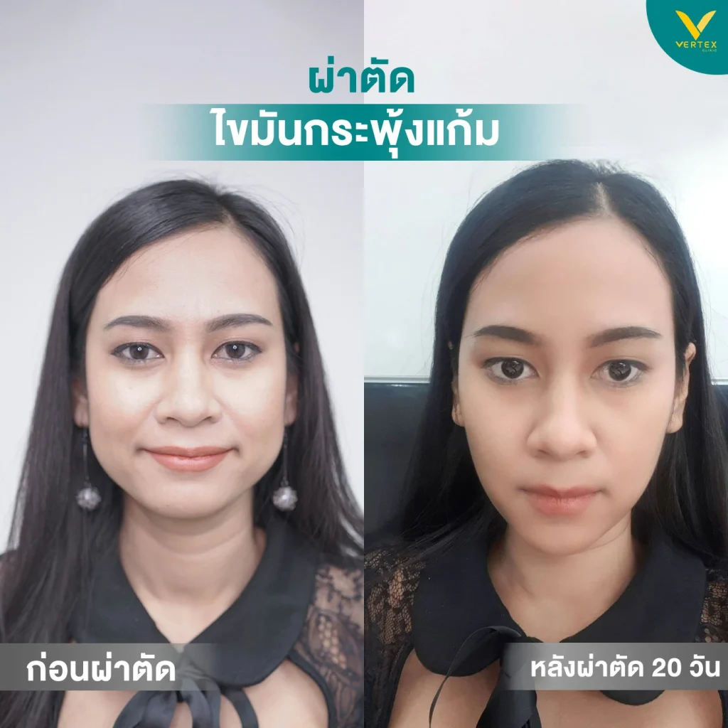 รีวิวไขมันกระพุ้งแก้ม-คุณนงลักษณ์