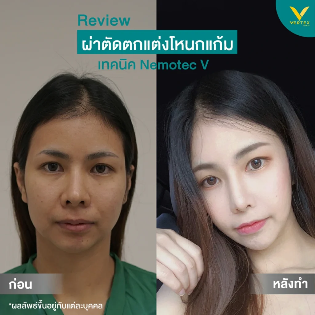 โหนกแก้ม-รีวิว