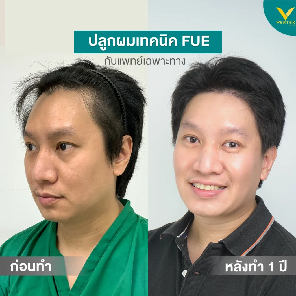 ปลูกผมพี่ตาร์