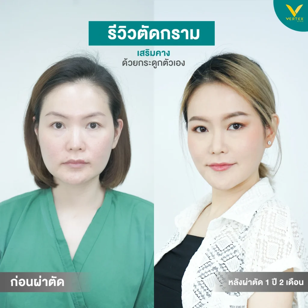 รีวิวตัดกราม-เสริมคาง