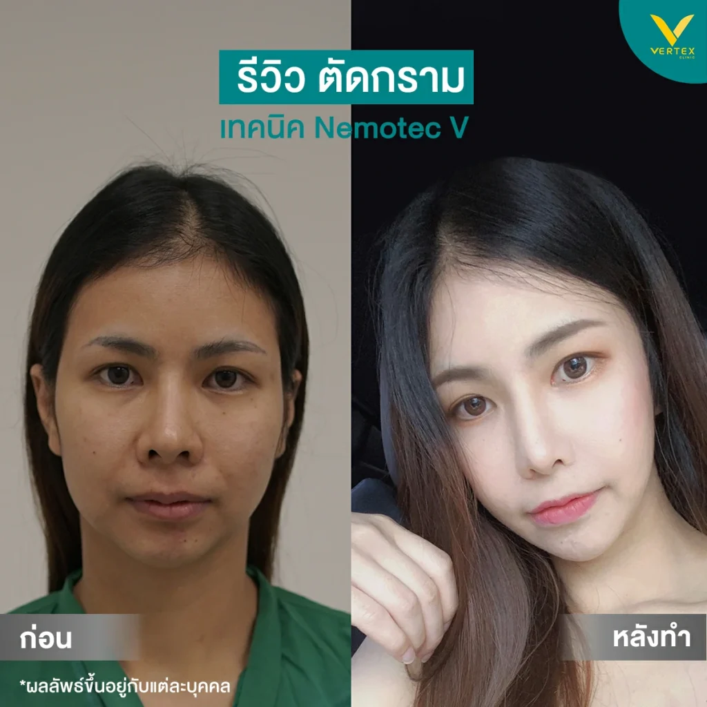 รีวิวตัดกราม