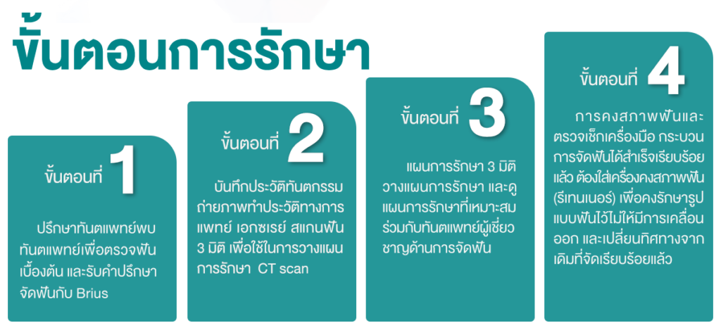 จัดฟันด้านใน-Brius