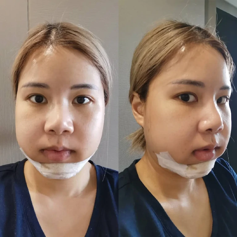 อัพเดท 4 วันหลังการผ่าตัด ไม่มัดฟัน ไม่มีสายเดรนด้วย ภาพหลังทำ หน้าตรงและหันข้าง