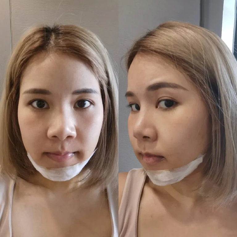 อัพเดทหน้าใหม่ หลังผ่าตัดแก้ปากอูม เพียง 7 วันเท่านั้น!! อัพเดท 7 วัน หันข้างและหน้าตรง